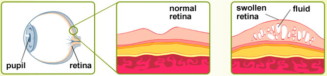 How Diabetic Macular Edema (DME) Affects Your Eyes